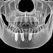 Dental Implants X-Ray